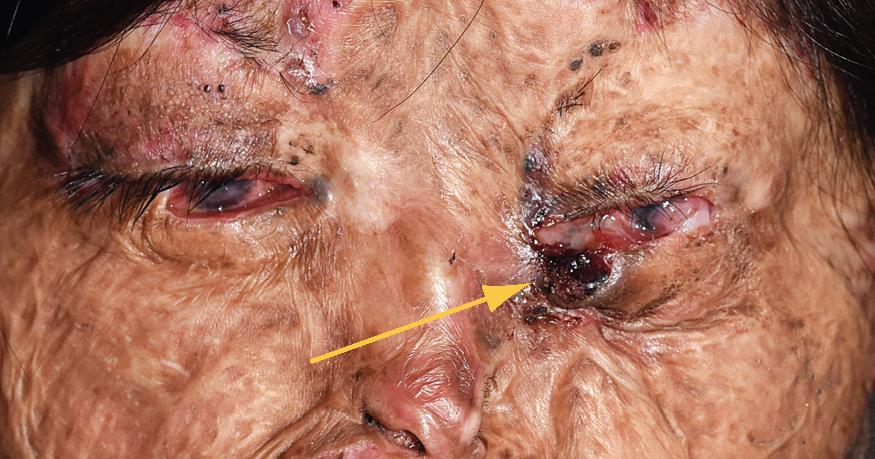 Xeroderma pigmentosum with an ulcerated basal cell carcinoma