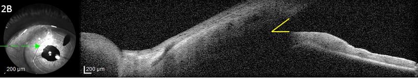 Figure 2B. Anterior segment optical coherence tomography showing a deep irido-corneal angle (outlined in yellow)