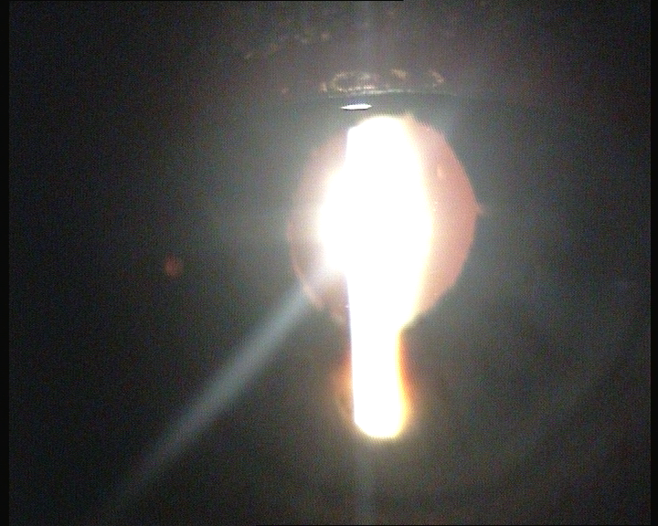 File:Nasal Iridotomy.png