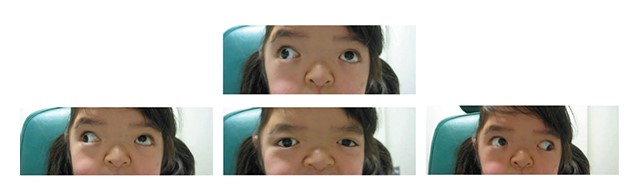 File:Strabismus Craniosynostosis.jpg