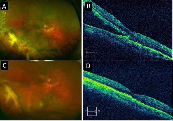 File:OCT before and after Avastin.jpg