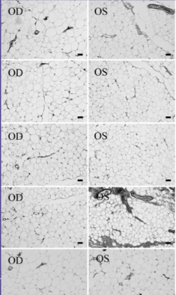 Fig 5: Histologic appearance of preaponeurotic fat of five different biopsy sites of a patient treated with bimatoprost in the left eye only. Right eye samples used as control. The cell density of the fat tissue is higher in the treated eye. Courtesy of Park et al.