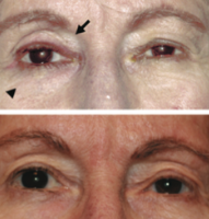 Fig 15: Patient on bimatoprost OD (top) and 3 months after switching to brimonidine (bottom). Courtesy of Filippopoulos et al.