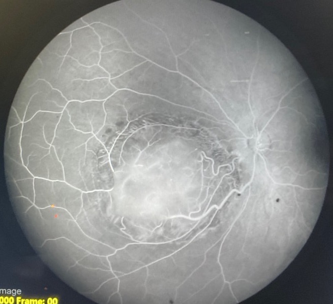 File:Fa retinoctyoma.jpg