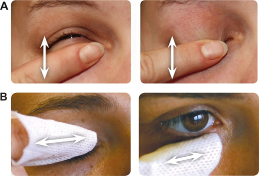 File:Eyelid Cleaning Procedure.png