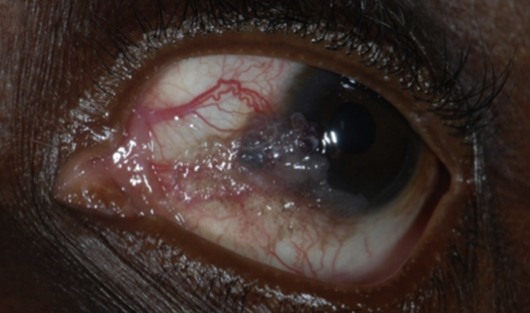 File:Carcinoma.png