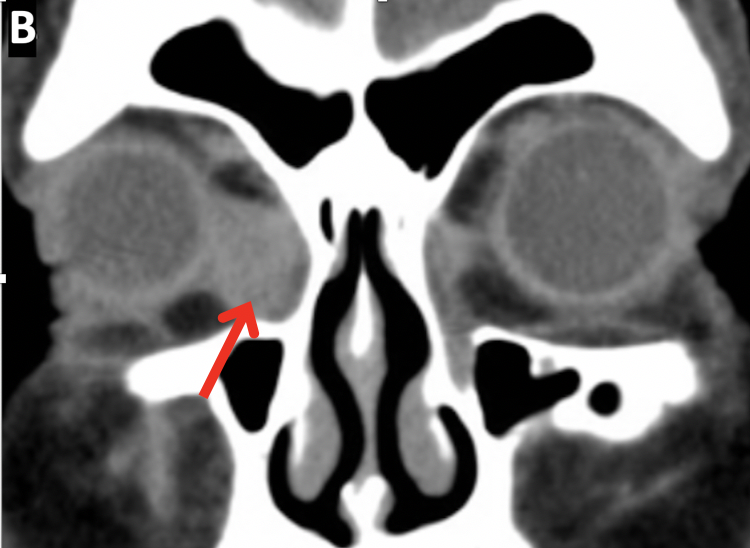 File:Lacrimal Sac tumor CT AB.png