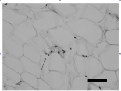 Fig 6: Microscopic findings of atrophied fat tissue in a bimatoprost treated eye as evidenced by clumped adipocyte nuclei, courtesy of Park et al.
