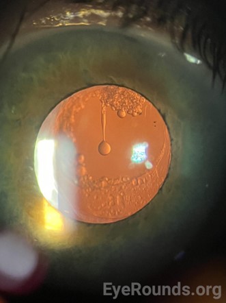 File:Elschnig pearl.jpg