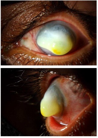 File:Exposure keratopathy.jpg