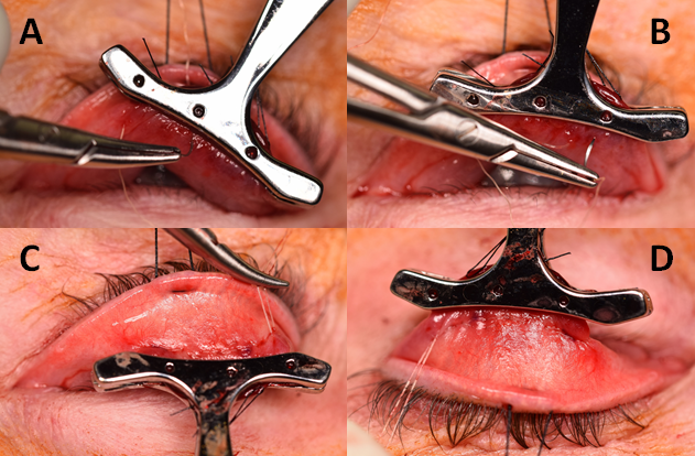 File:MMCR Eyewiki Figure 7.png