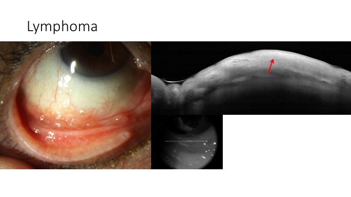 File:AS-OCT lymphoma.jpeg