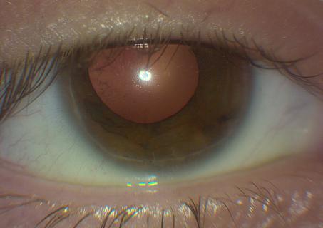 Posterior embryotoxon.JPG