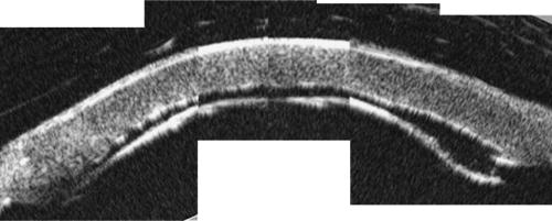 File:Post-DALK pseudo anterior chamber.jpeg