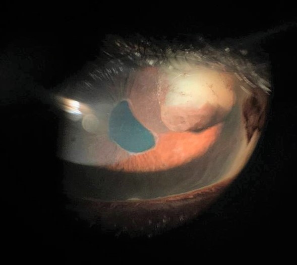 File:Iris cyst 1.jpeg