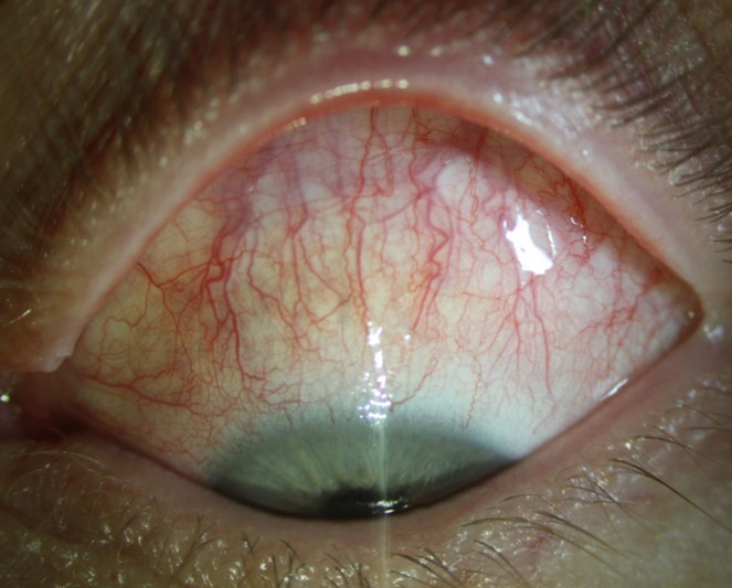 File:Figure 3 Slit Lamp Photo Episcleritis.jpg