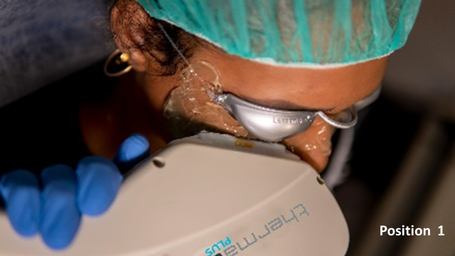File:IPL treatment A2.png