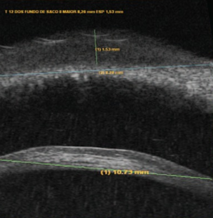 File:Conjunctival RLH - Figure 2.png