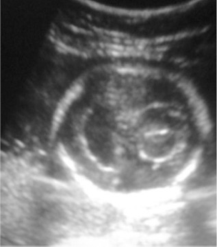 File:Cyclopia ultrasound.jpg