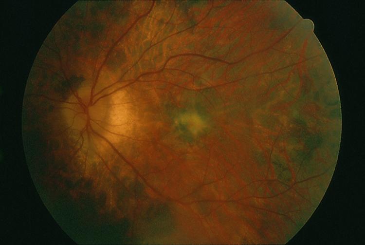 Acute Zonal Occult Outer Retinopathy (AZOOR) - EyeWiki