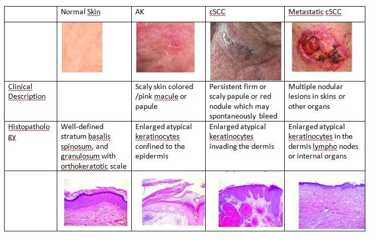 Figure 5.A clinical, histologic, and molecular comparison of AKs, cSCC, and metastatic cSCC Adapted from Ratushny, V., Gober, M. D., Hick, R., Ridky, T. W., & Seykora, J. T. (2012). From keratinocyte to cancer: the pathogenesis and modeling of cutaneous squamous cell carcinoma. The Journal of Clinical Investigation, 122(2), 464–47 Images kindly lent by Patricia Henriques Lyra Frasson M.D. , MSc - Federal University of Espirito Santo