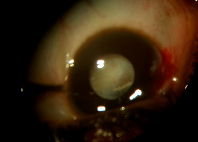 File:Figure 6. Intracapsular location.jpg