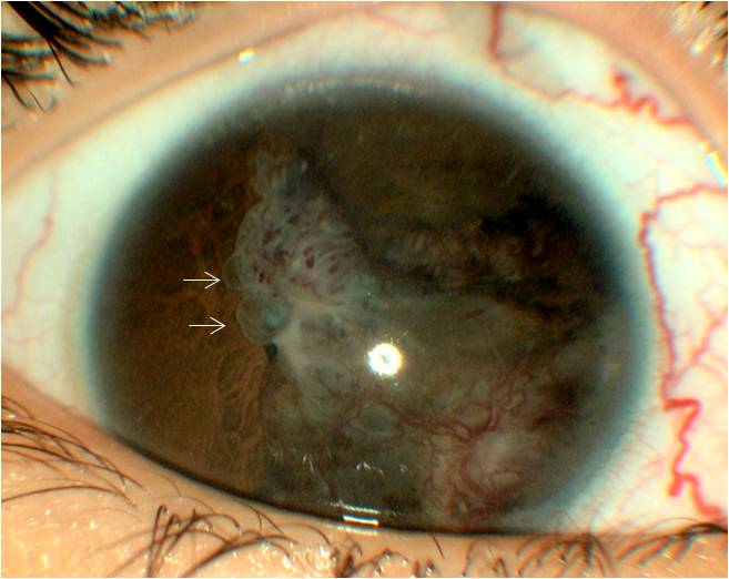 File:Medulloepithelioma Iris Cysts.jpg