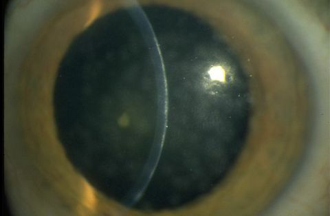 Epidemic keratoconjunctivitis.