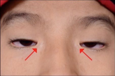 File:Epicanthus inversus.png