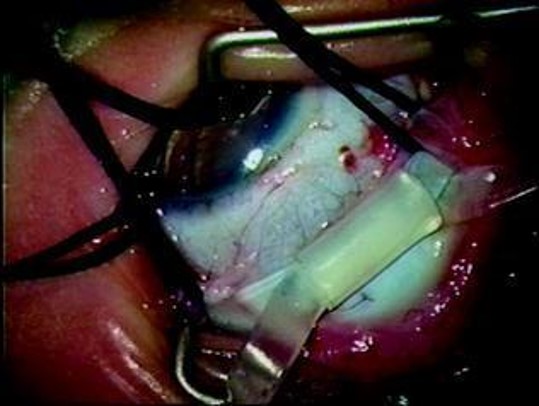 File:Scleral buckling .jpg