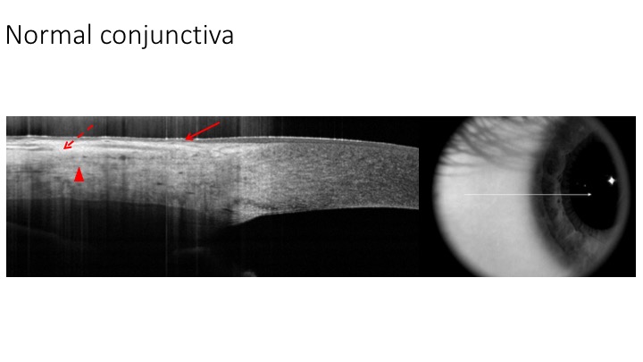 File:AS-OCT of normal conjunctiva.jpeg
