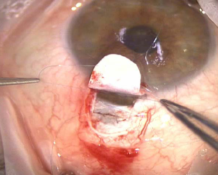 File:Tie prolene to dilate schlemm's canal.png