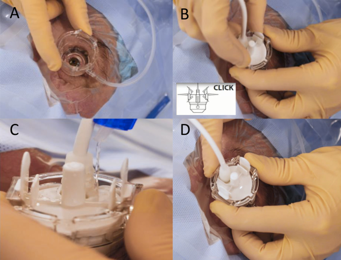 File:Cycloplasty figure.jpg