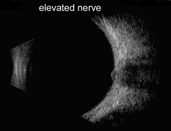 File:Fig 1 elevated optic nerve.png