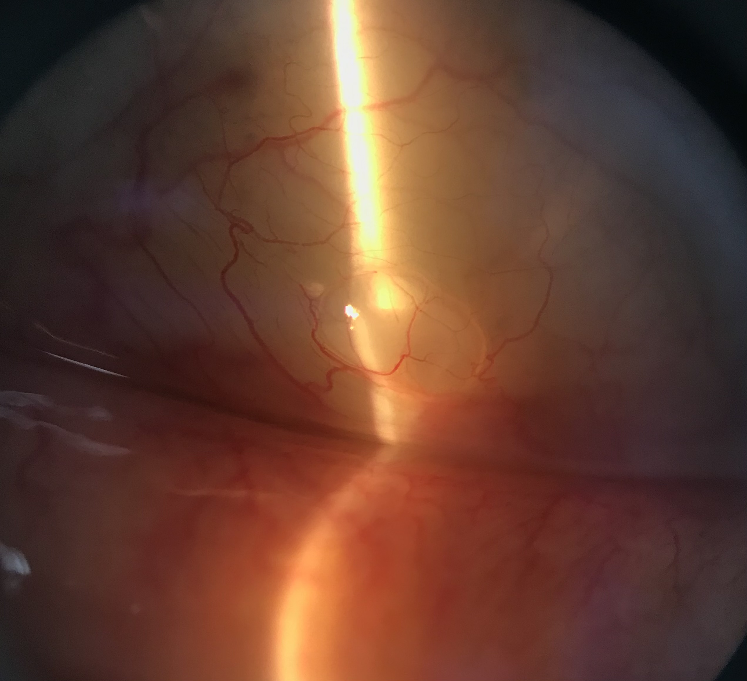 Conjunctival inclusion cyst
