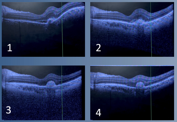 File:OCT macula in TAGU.png