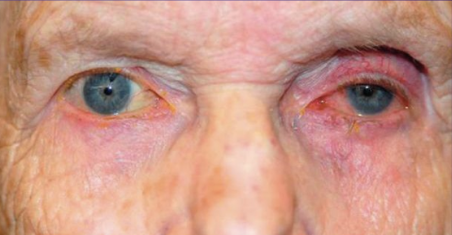 Fig 10: Patient treated with bimatoprost in the left eye only. Not the relative deepened sulcus, ptosis, and enophthalmos in addition to the injected ocular surface and prominence of lid vessels on the left side.