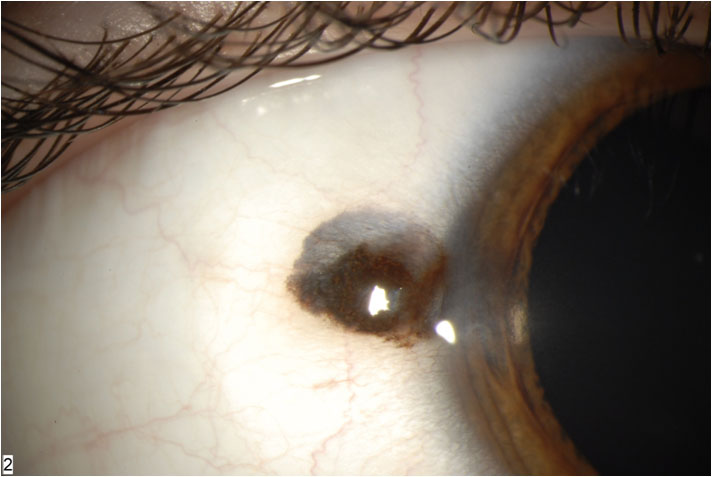 File:Fig. 1A - conj combined nevus clinical.jpg