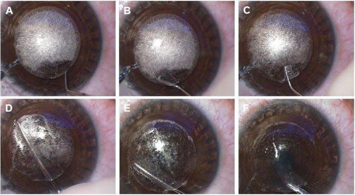 File:SMILE Lenticule Dissection.jpg