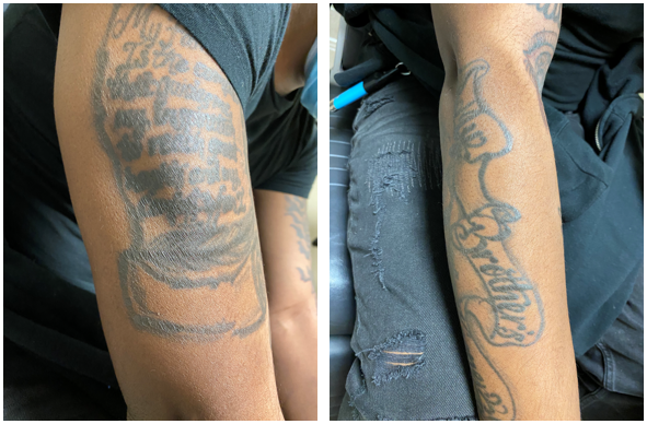 File:TAGU after PO steroid.png