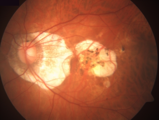 File:Myopic degeneration.jpeg