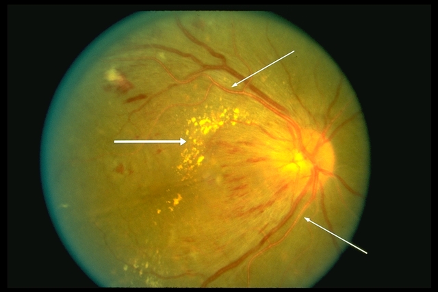 File:Malignant HTN RET.jpg