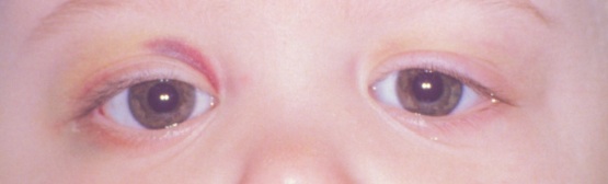 File:Raccoon eyes post.jpg