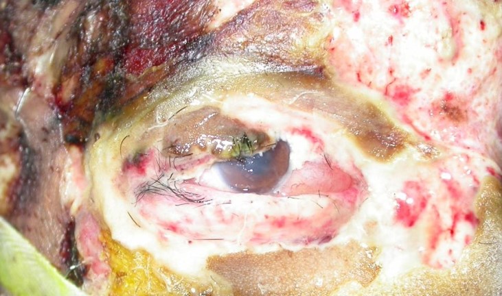 File:4th degree - full thickness.jpg