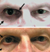 Fig 16: Patient on bimatoprost OD (top) and 6 months after discontinuation (bottom). Courtesy of Filippopoulos et al.