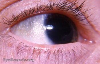 File:Conjunctival xerosis.jpg