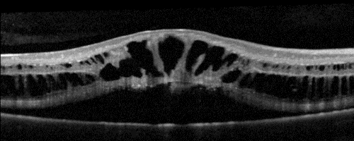 File:OCT Retinoschisis.png