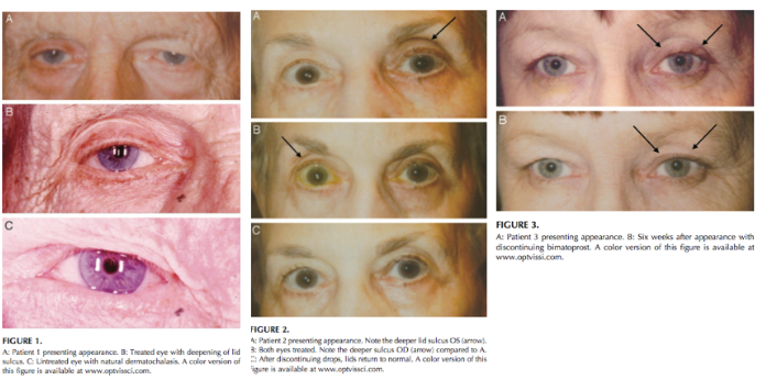 Fig 1: Original case series of 3 patients showing PAP, courtesy of Peplinski et al.