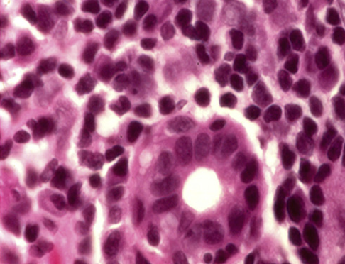 File:Accesory salivary gland in a patient with GVHD.png