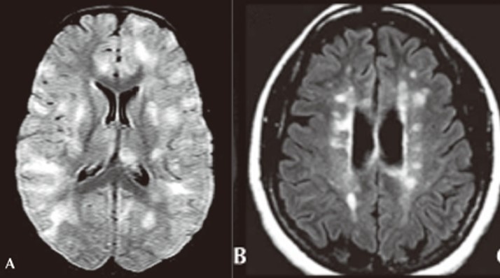 File:ADEM figure 1.jpeg